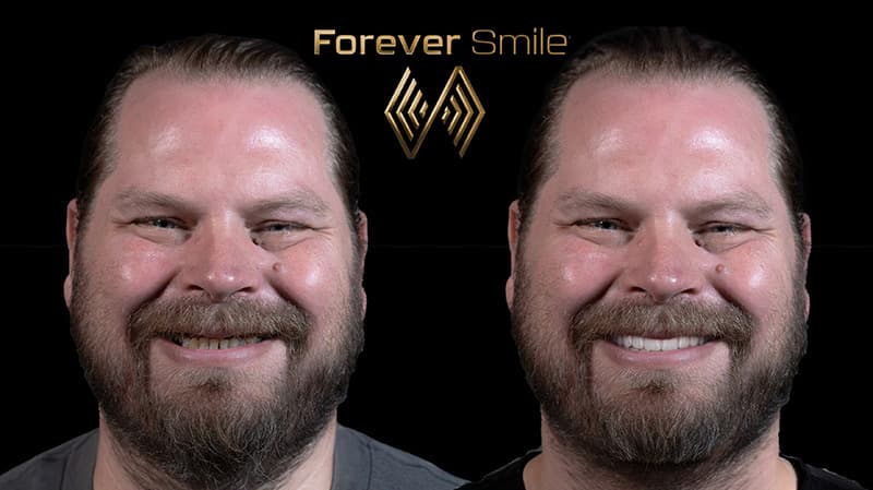 Before and after smile transformation 1