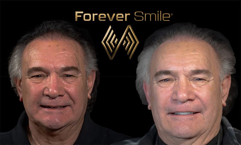 Before and after smile transformation 2
